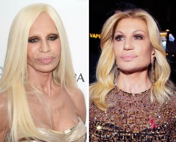 facelift